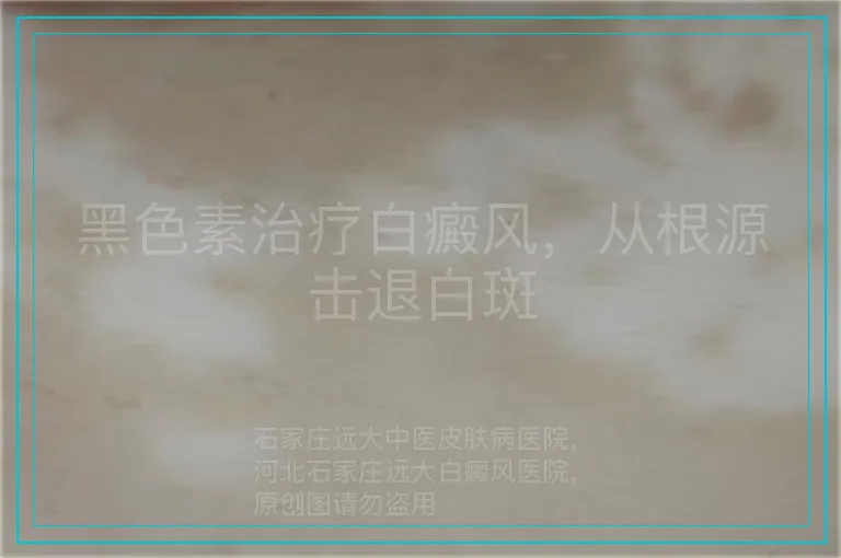 黑色素治疗白癜风，从根源击退白斑
