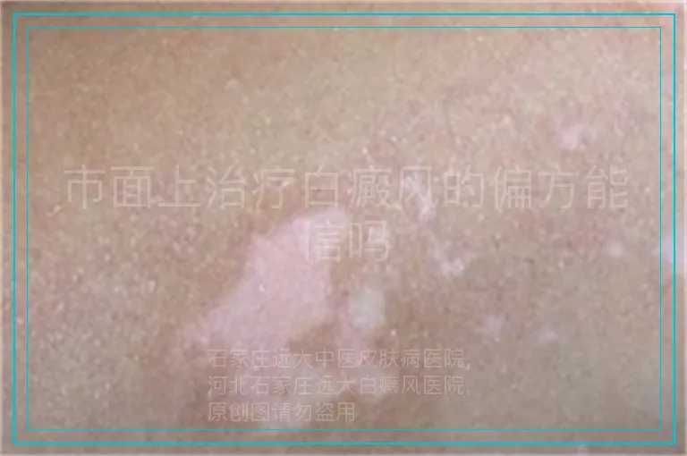 市面上治疗白癜风的偏方能信吗