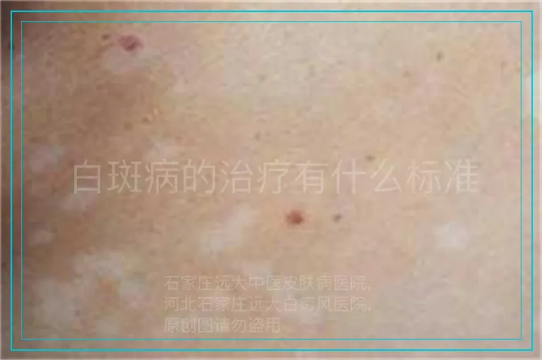白斑病的治疗有什么标准