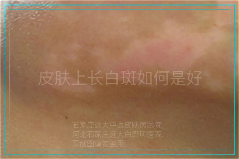皮肤上长白斑如何是好
