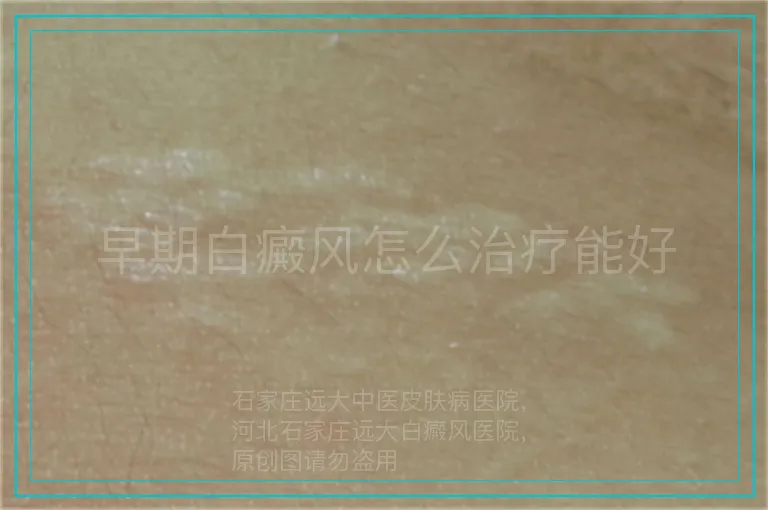 早期白癜风怎么治疗能好