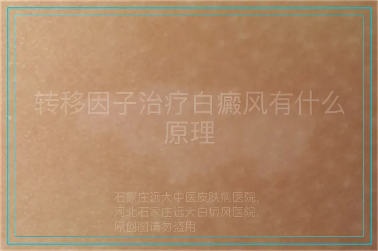 转移因子治疗白癜风有什么原理