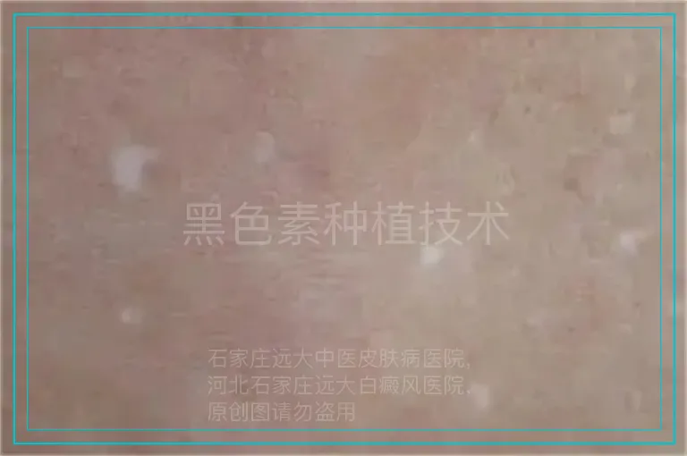 黑色素种植技术