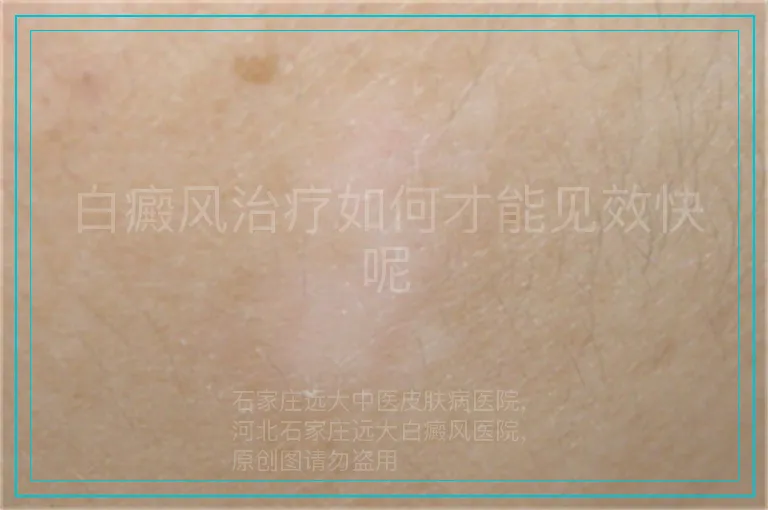 白癜风治疗如何才能见效快呢