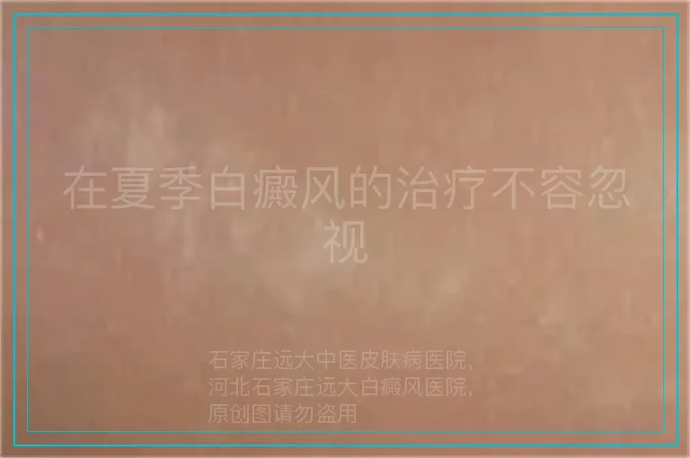 在夏季白癜风的治疗不容忽视