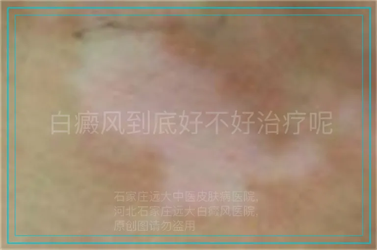 白癜风到底好不好治疗呢