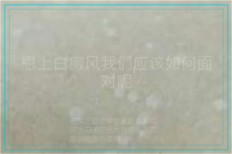 患上白癜风我们应该如何面对呢