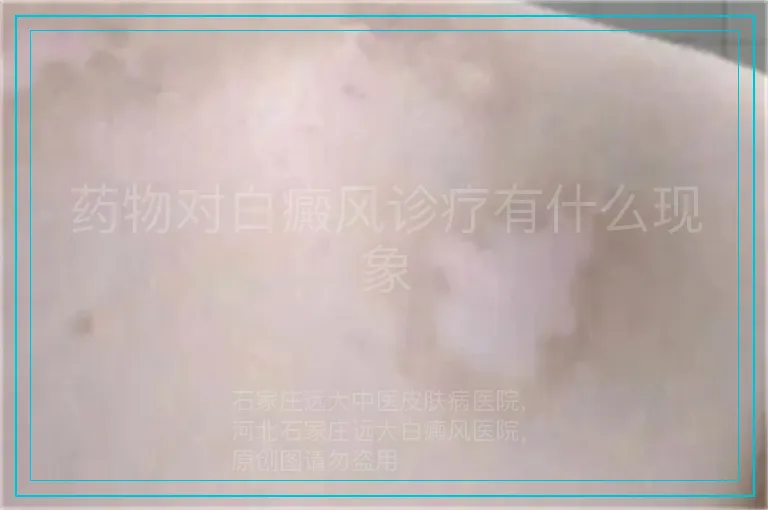 药物对白癜风诊疗有什么现象