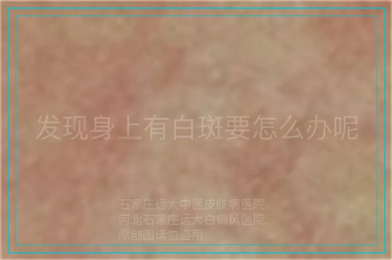发现身上有白斑要怎么办呢