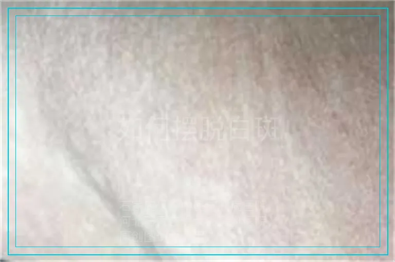 如何摆脱白斑
