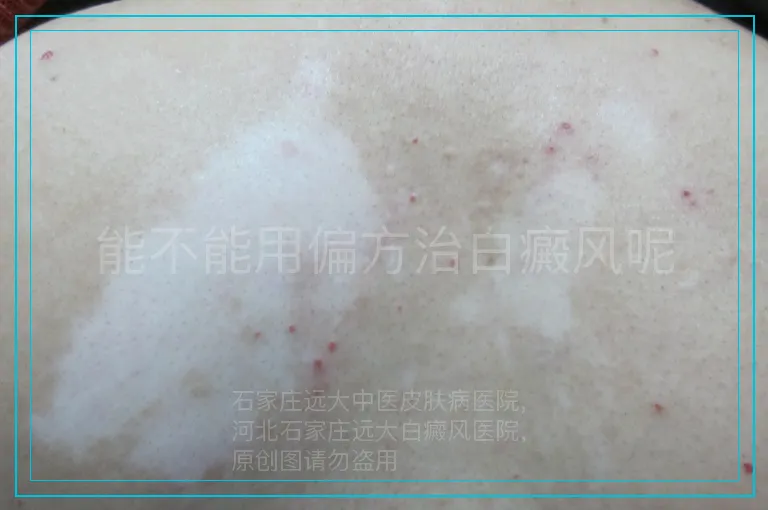 能不能用偏方治白癜风呢