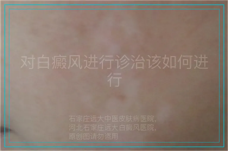 对白癜风进行诊治该如何进行