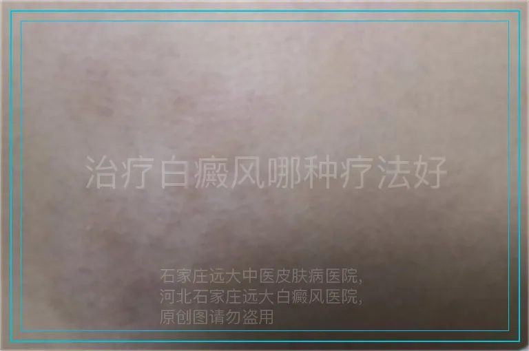 治疗白癜风哪种疗法好