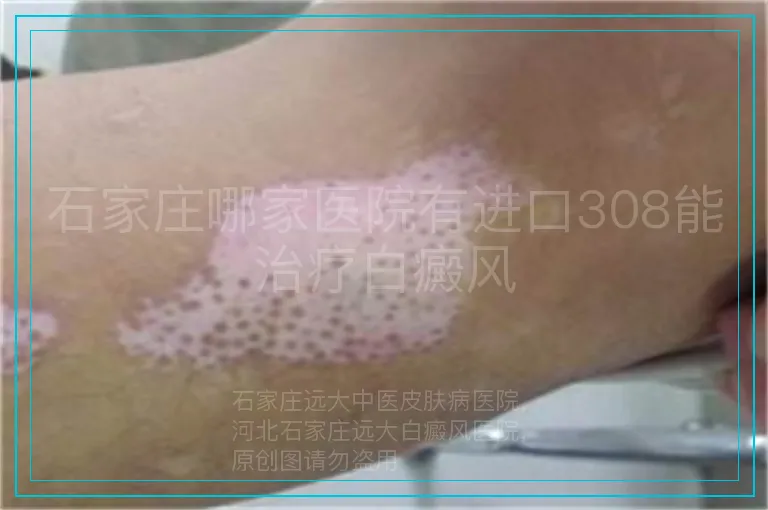 石家庄哪家医院有进口308能治疗白癜风
