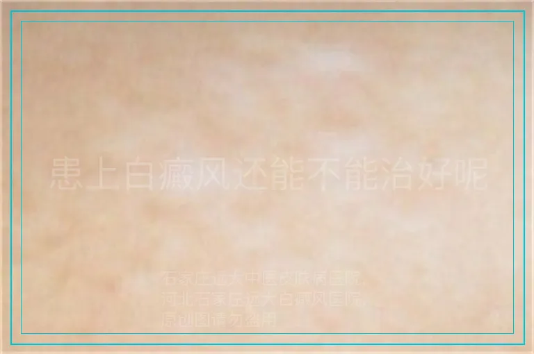 患上白癜风还能不能治好呢