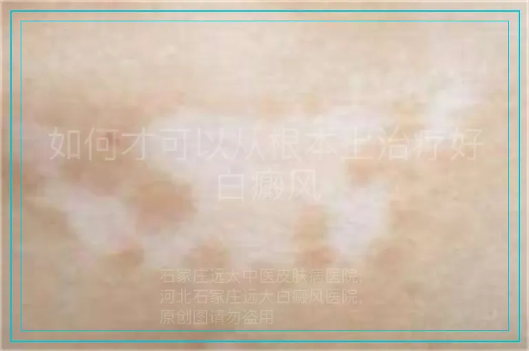 如何才可以从根本上治疗好白癜风