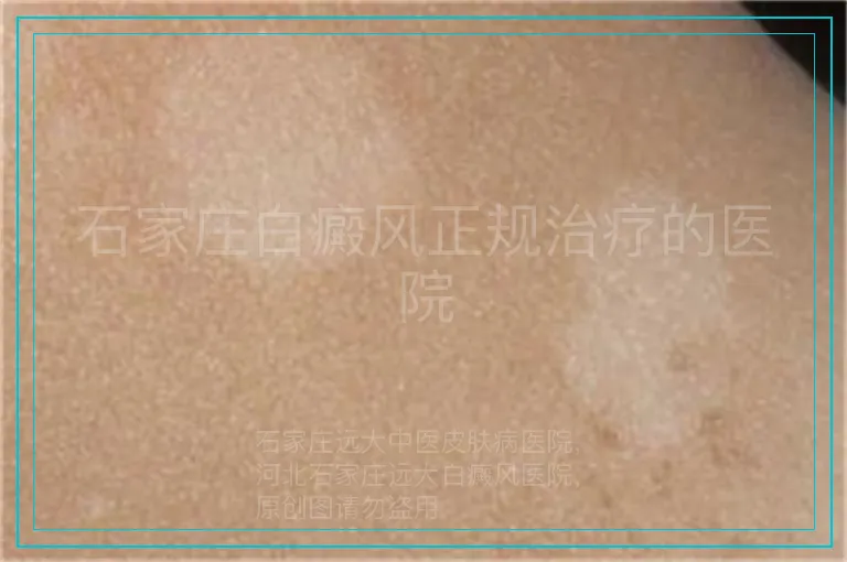 石家庄白癜风正规治疗的医院
