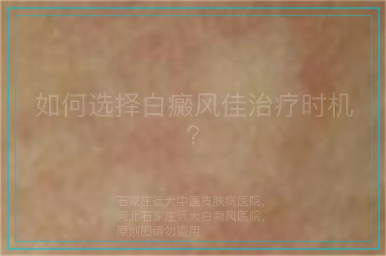如何选择白癜风佳治疗时机？