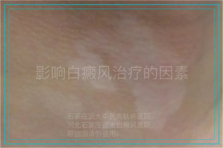影响白癜风治疗的因素