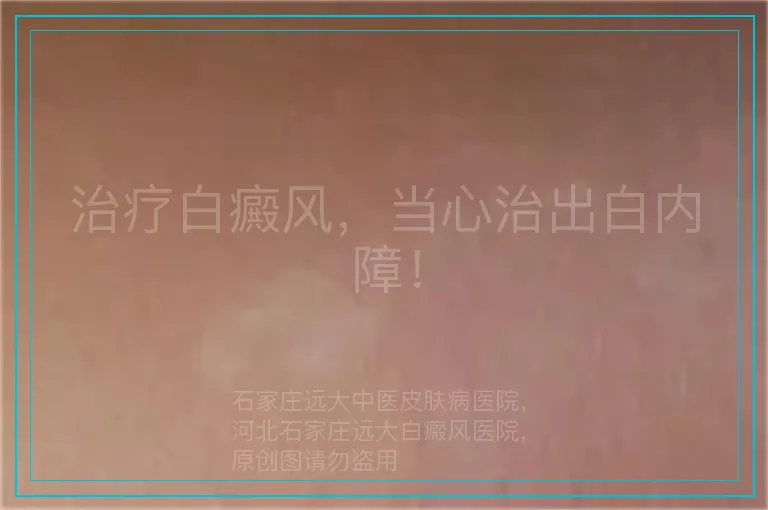治疗白癜风，当心治出白内障！