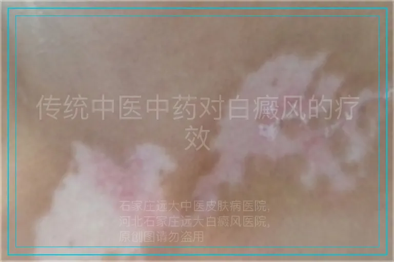 传统中医中药对白癜风的疗效