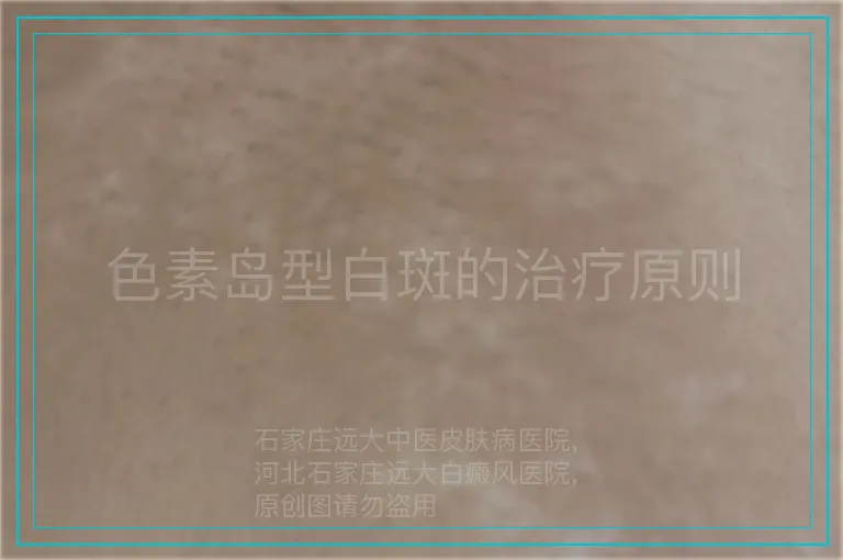 色素岛型白斑的治疗原则