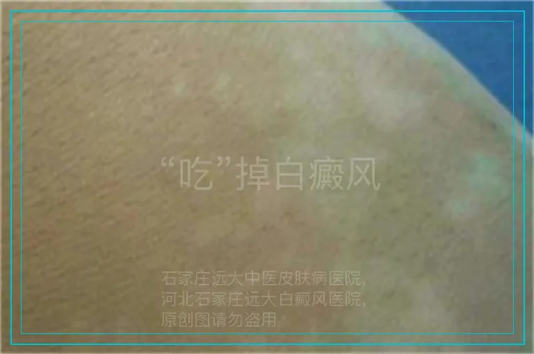 “吃”掉白癜风