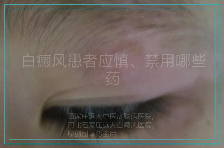 白癜风患者应慎、禁用哪些药