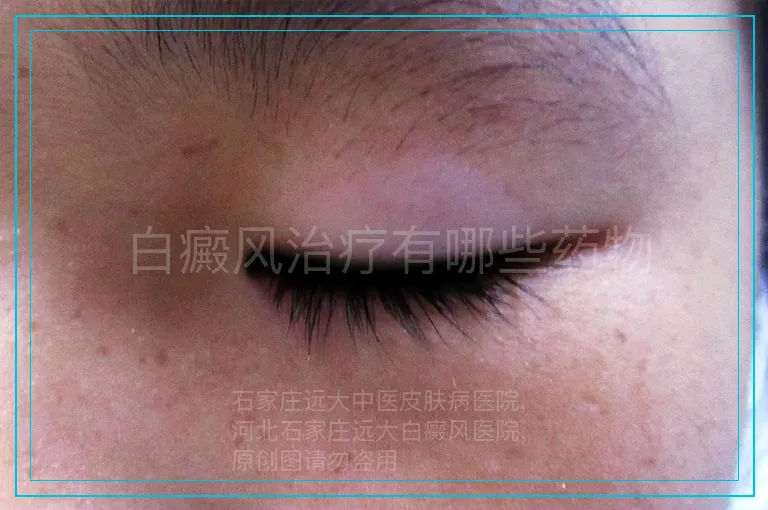 白癜风治疗有哪些药物