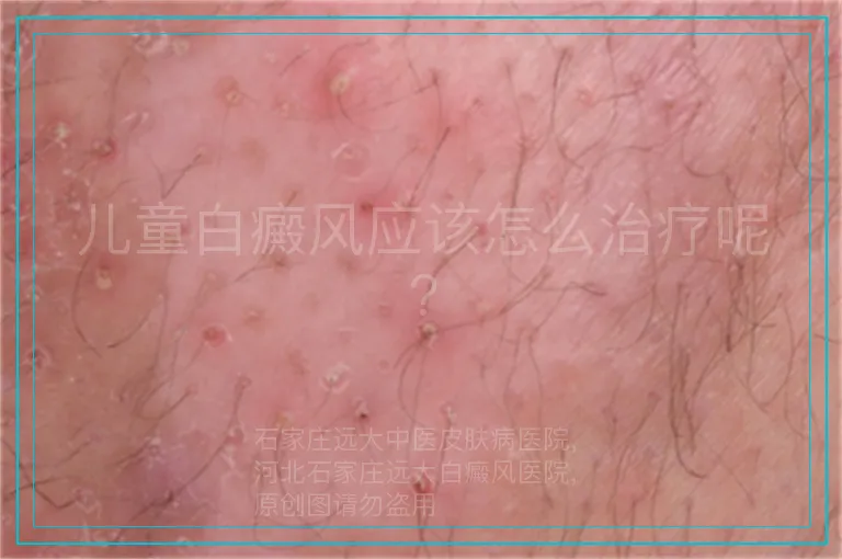 儿童白癜风应该怎么治疗呢?