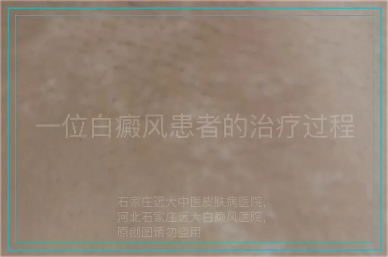 一位白癜风患者的治疗过程