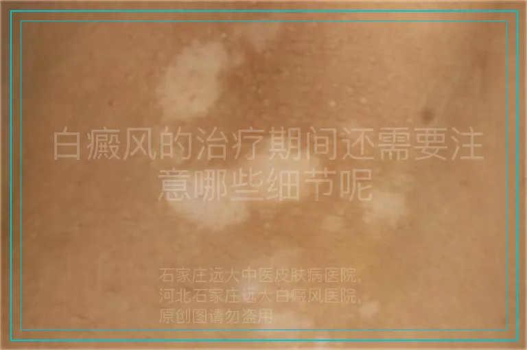 白癜风的治疗期间还需要注意哪些细节呢