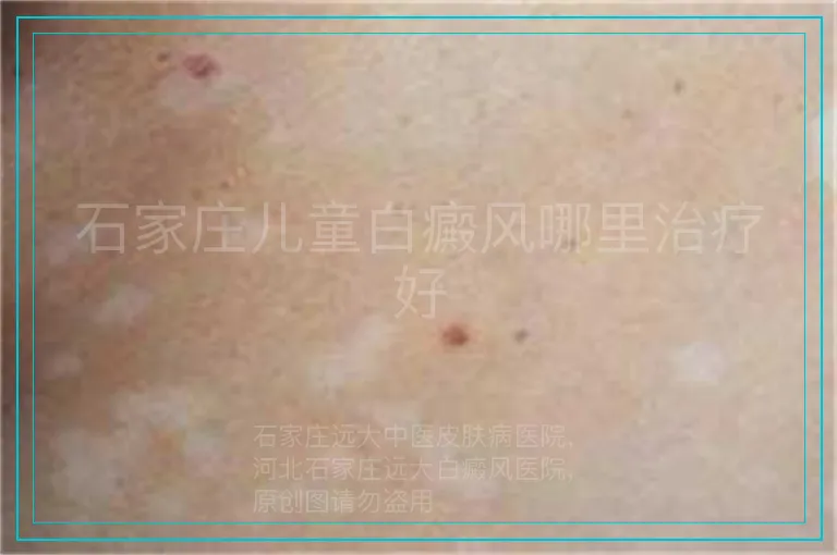 石家庄儿童白癜风哪里治疗好