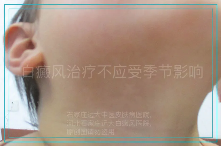 白癜风治疗不应受季节影响