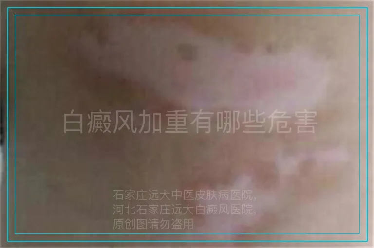 白癜风加重有哪些危害