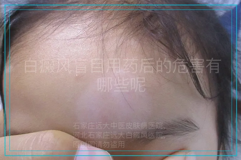 白癜风盲目用药后的危害有哪些呢