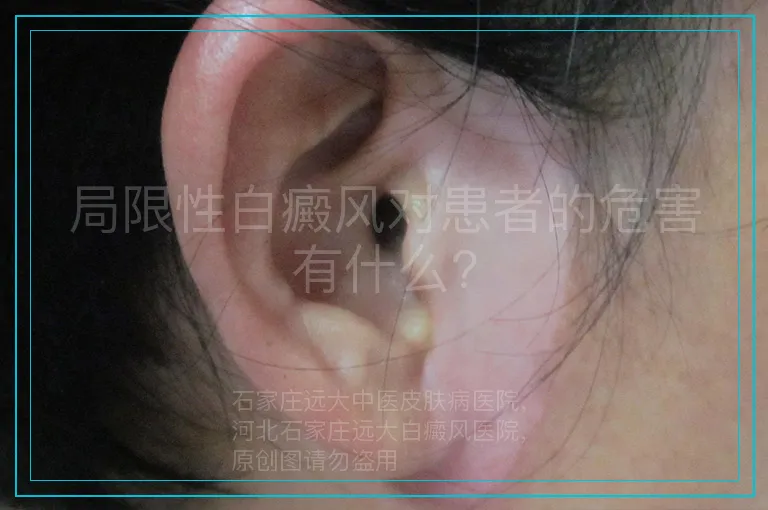 局限性白癜风对患者的危害有什么?