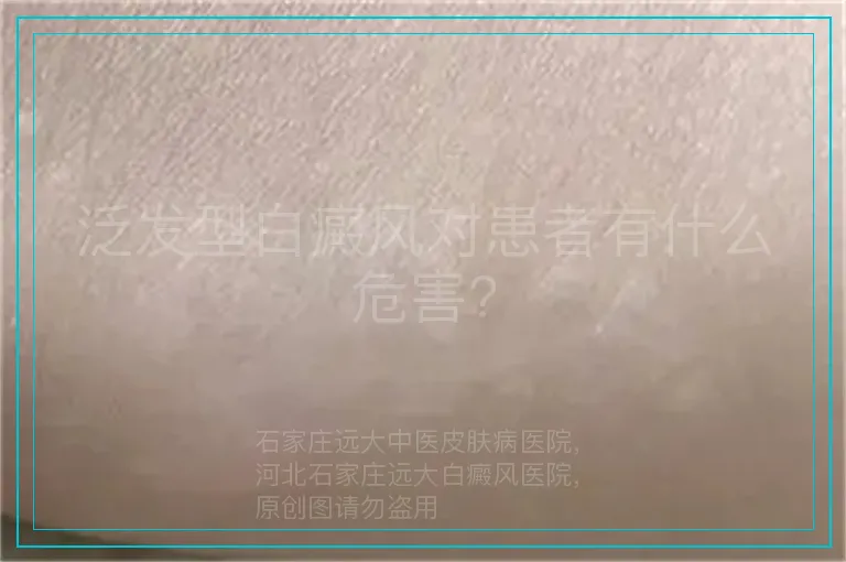 泛发型白癜风对患者有什么危害?