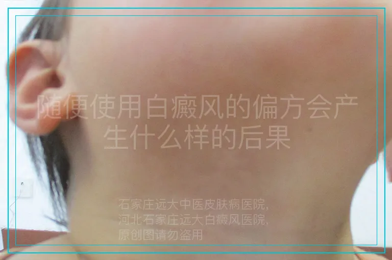 随便使用白癜风的偏方会产生什么样的后果