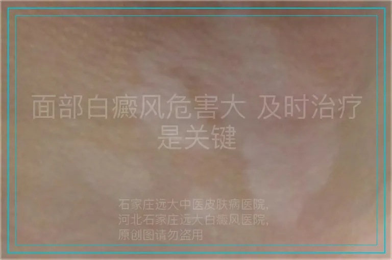 面部白癜风危害大 及时治疗是关键
