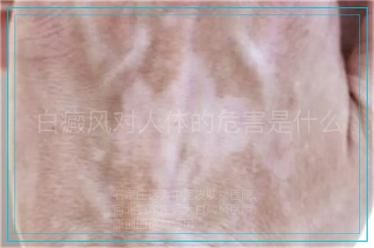 白癜风对人体的危害是什么