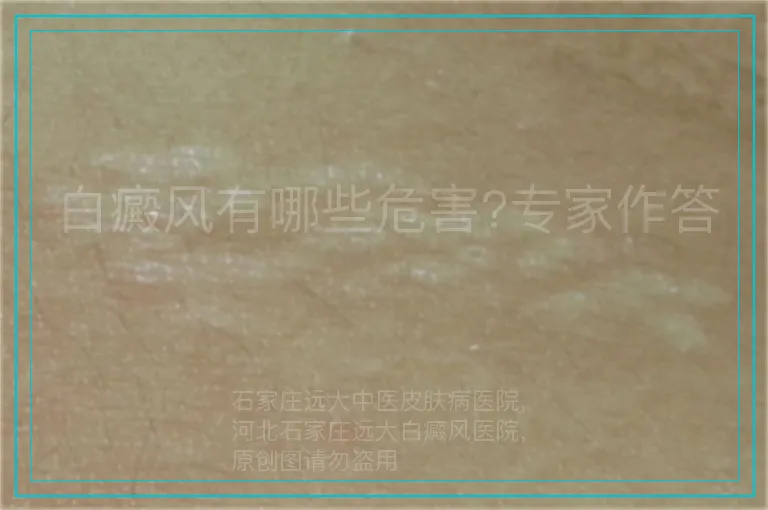白癜风有哪些危害?专家作答