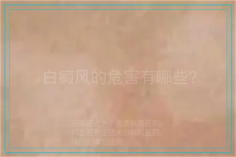 白癜风的危害有哪些?