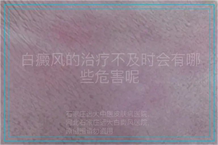 白癜风的治疗不及时会有哪些危害呢
