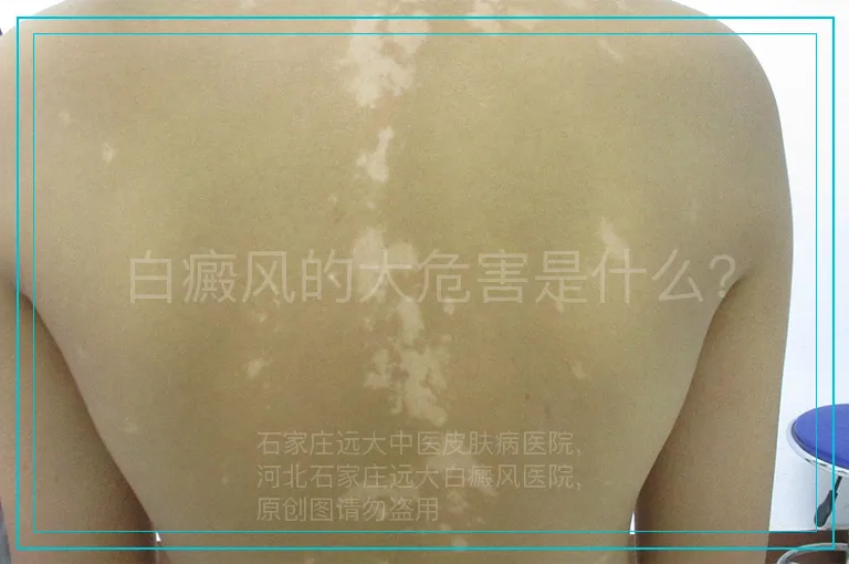 白癜风的大危害是什么？