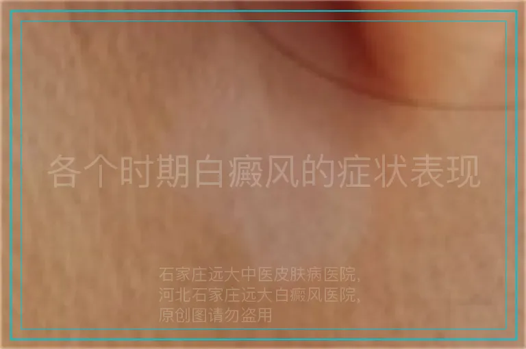 各个时期白癜风的症状表现