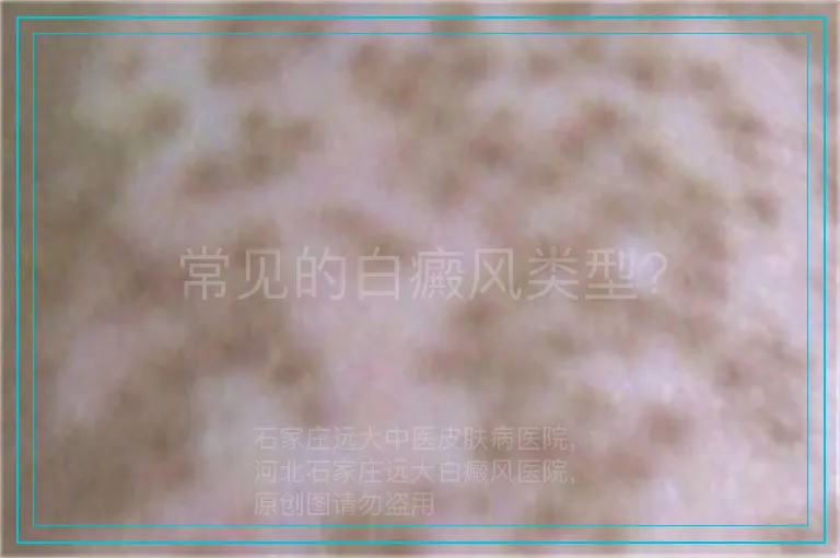 常见的白癜风类型？