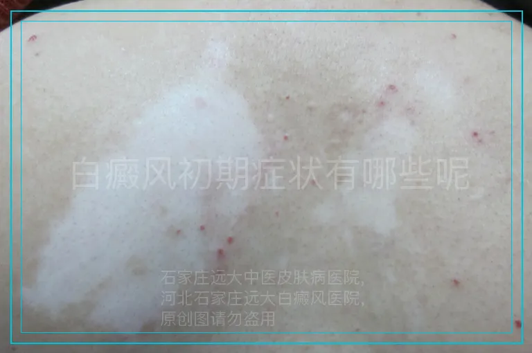 白癜风初期症状有哪些呢