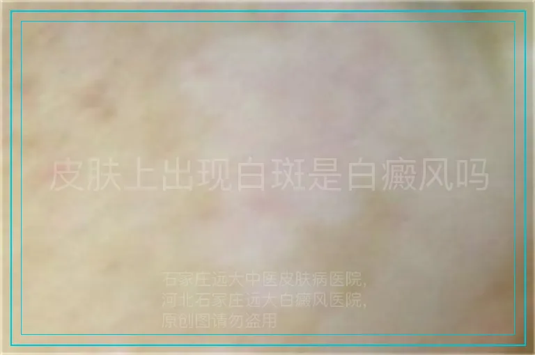 皮肤上出现白斑是白癜风吗
