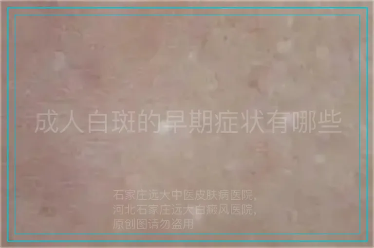 成人白斑的早期症状有哪些